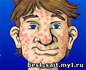 Acne Be Gone